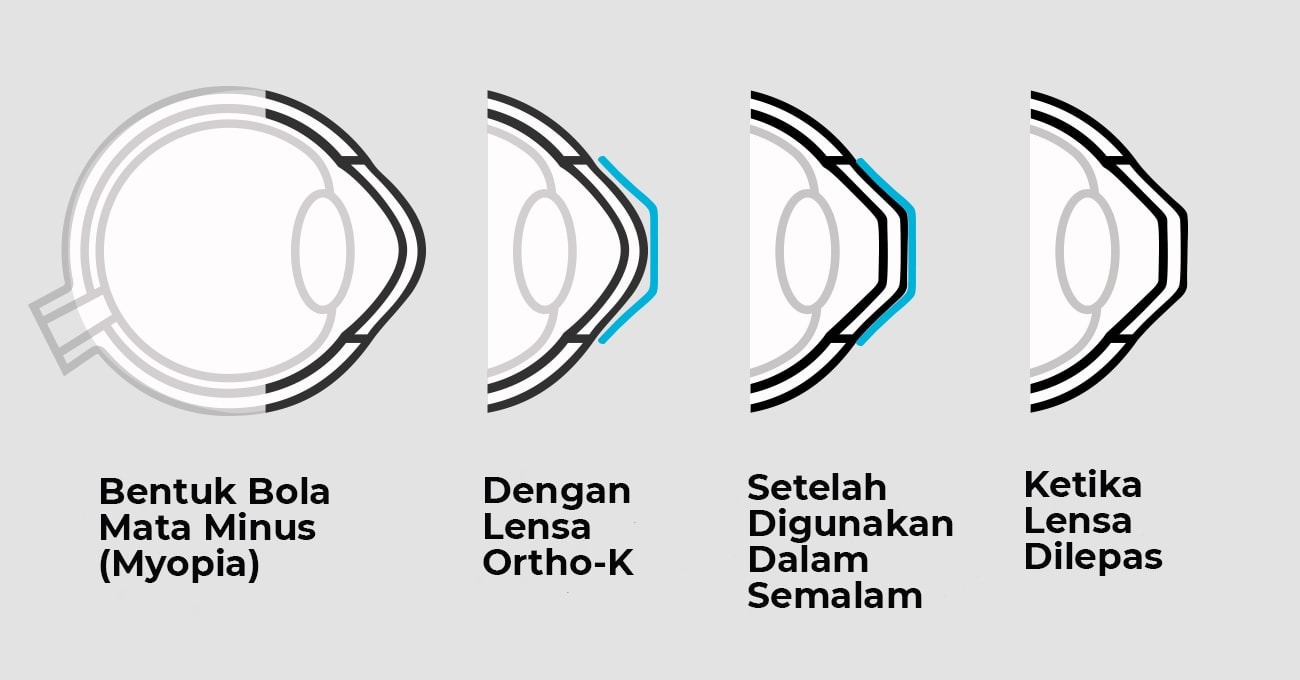 proses penyembuhan mata minus dengan terapi ortho-k