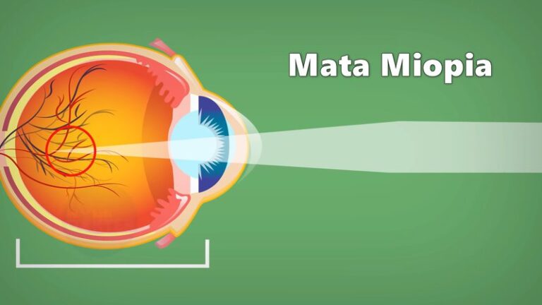 sketsa gambar mata miopia atau rabun jauh
