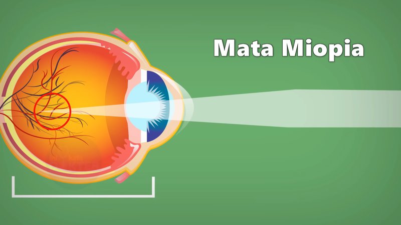 penjelasan kenapa mata bisa minus atau Miopia