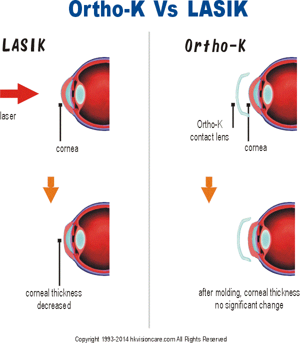 terapi Ortho K vs operasi Lasik